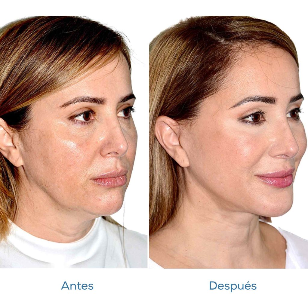 Lifting Facial