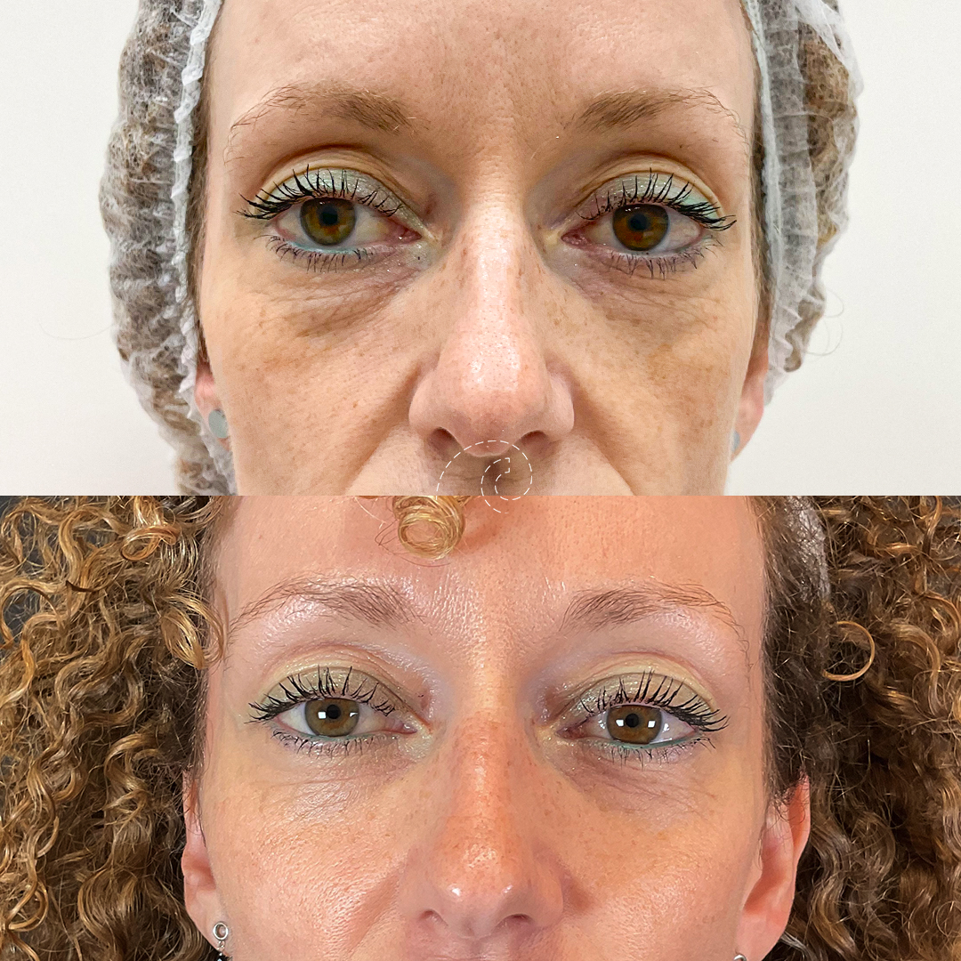 Blefaroplastia