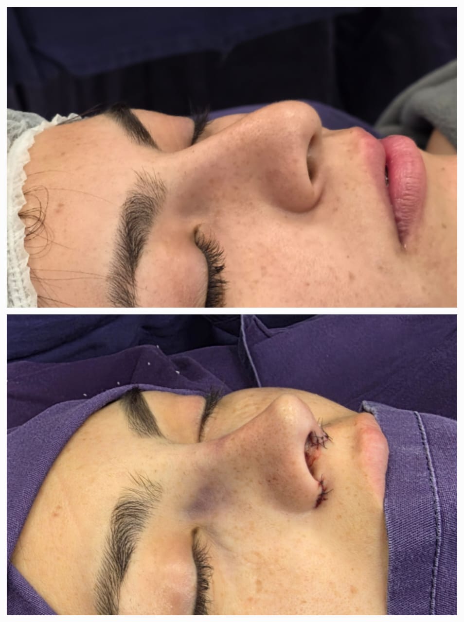 Rinoplastia